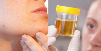 orinoterapia beneficios en la piel